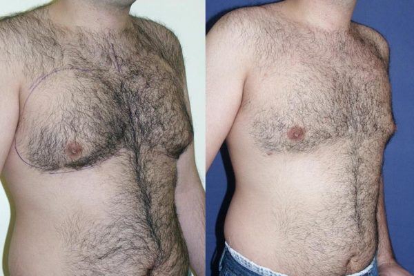 Gynecomastie Before After
