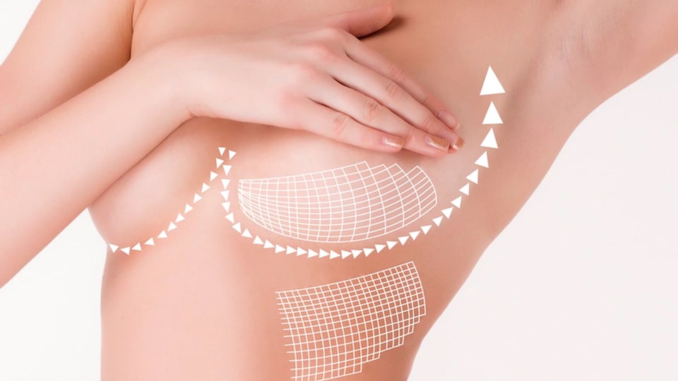About Breast Lift Surgery