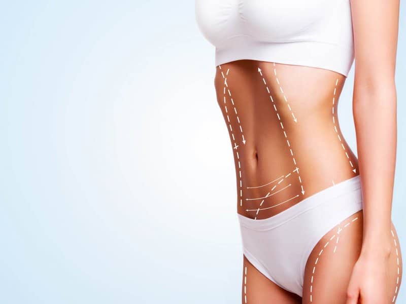 Vaser Liposuction Tekniği Nedir?