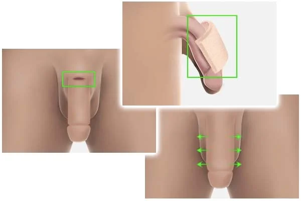 Penis Extender Male Dick Enlargement Edge Stretcher Pump Strap Extension  Penis Enlarger Erection Device